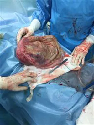 خارج کردن تومور 10 کیلوئی از شکم خانم 37 ساله 