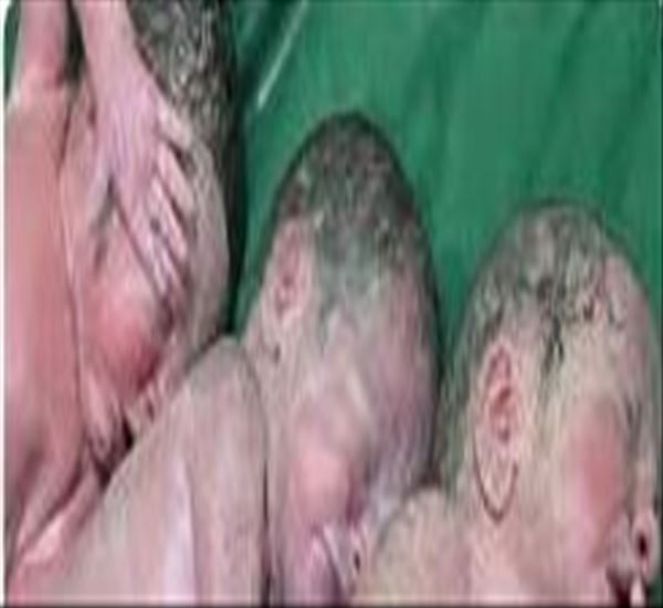 تولد سه قلوها در مرکز
